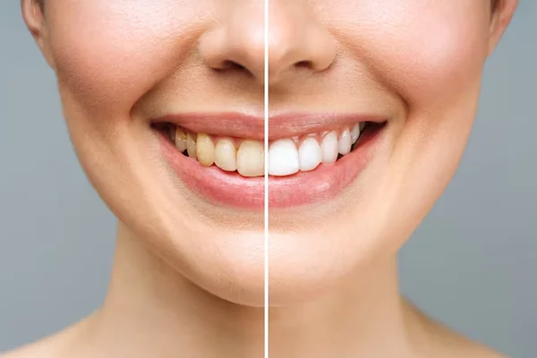 Teeth Whitening and Cosmetic Care