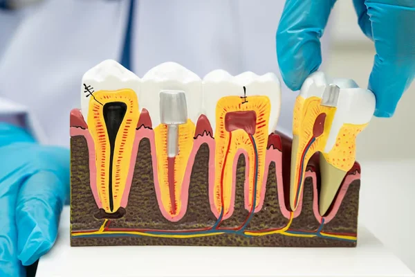 Root Canal and Pulp Care