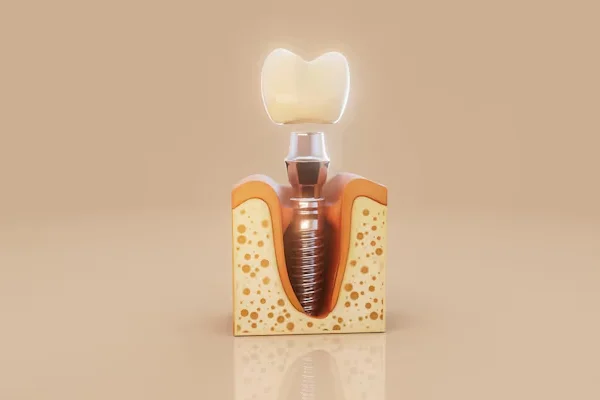 Dental Implants